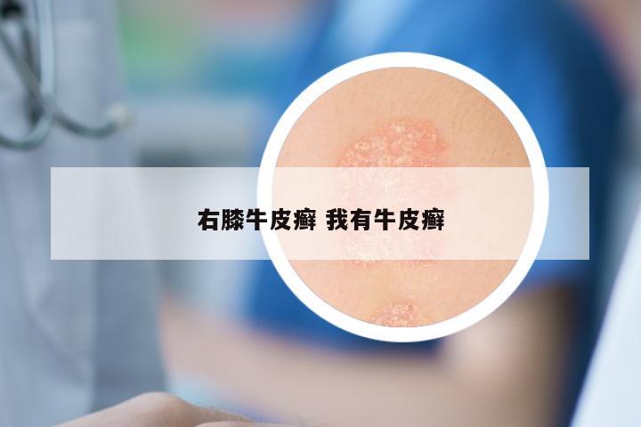 右膝牛皮癣 我有牛皮癣