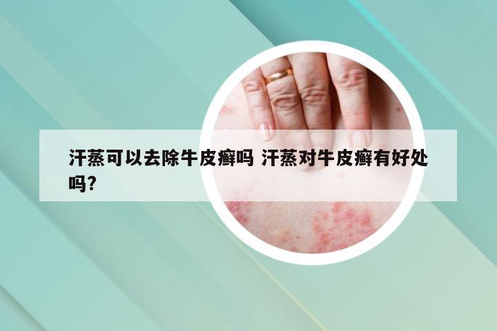 汗蒸可以去除牛皮癣吗 汗蒸对牛皮癣有好处吗?