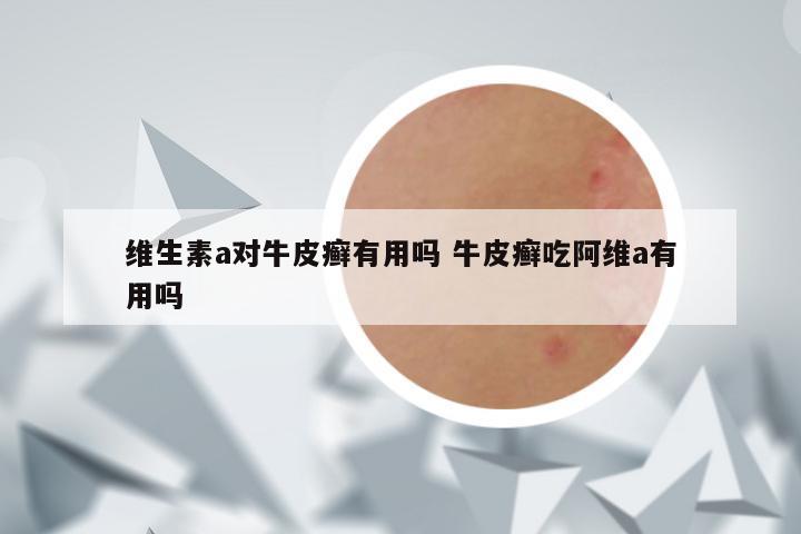 维生素a对牛皮癣有用吗 牛皮癣吃阿维a有用吗
