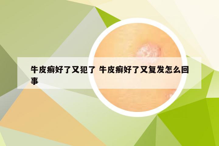 牛皮癣好了又犯了 牛皮癣好了又复发怎么回事