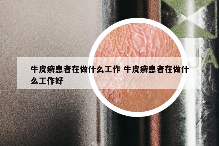 牛皮癣患者在做什么工作 牛皮癣患者在做什么工作好