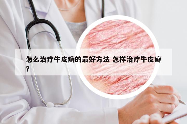 怎么治疗牛皮癣的最好方法 怎样治疗牛皮癣?