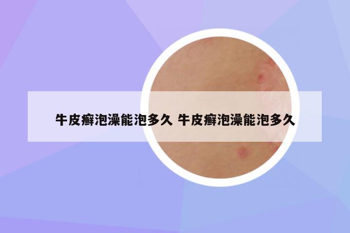 牛皮癣泡澡能泡多久 牛皮癣泡澡能泡多久