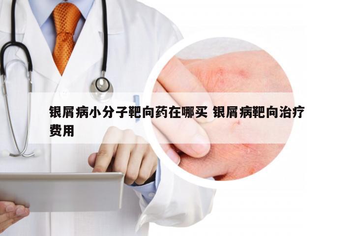 银屑病小分子靶向药在哪买 银屑病靶向治疗费用