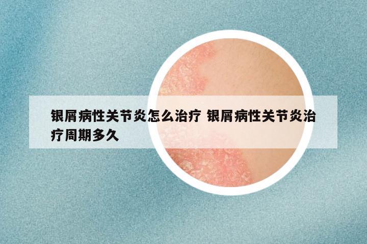 银屑病性关节炎怎么治疗 银屑病性关节炎治疗周期多久