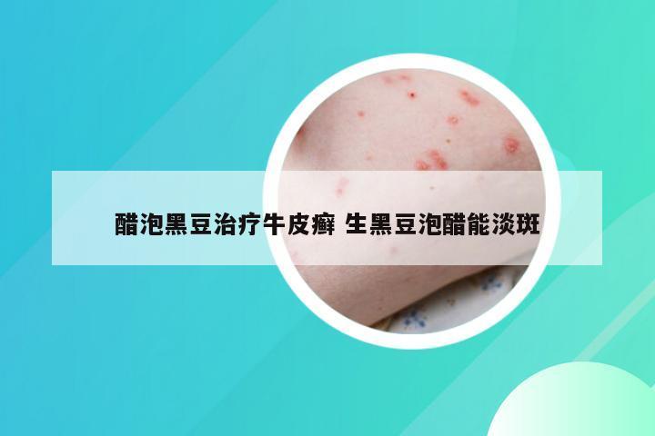 醋泡黑豆治疗牛皮癣 生黑豆泡醋能淡斑