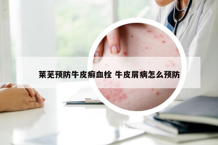 莱芜预防牛皮癣血栓 牛皮屑病怎么预防