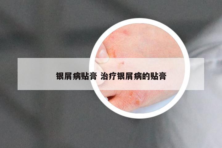 银屑病贴膏 治疗银屑病的贴膏