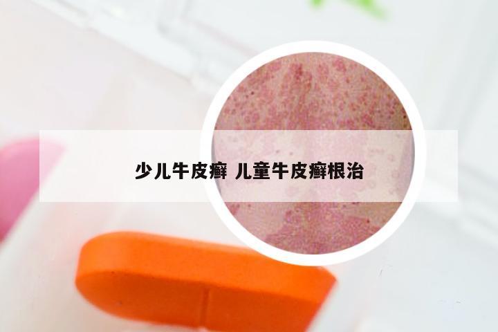 少儿牛皮癣 儿童牛皮癣根治