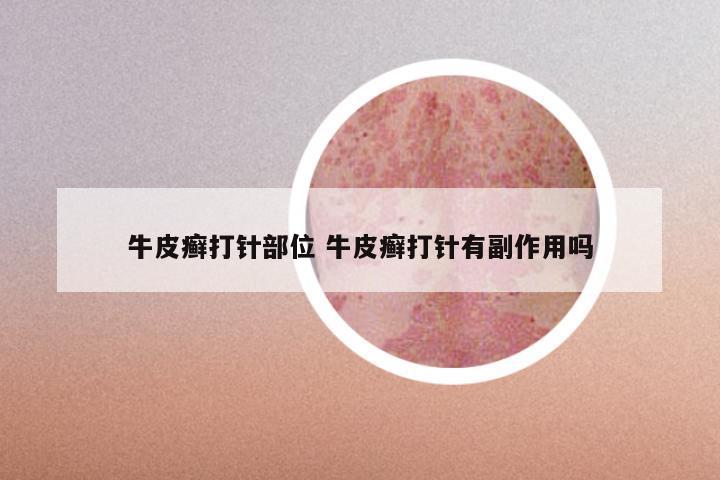 牛皮癣打针部位 牛皮癣打针有副作用吗