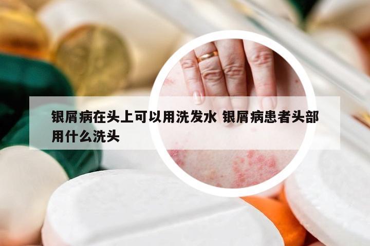 银屑病在头上可以用洗发水 银屑病患者头部用什么洗头