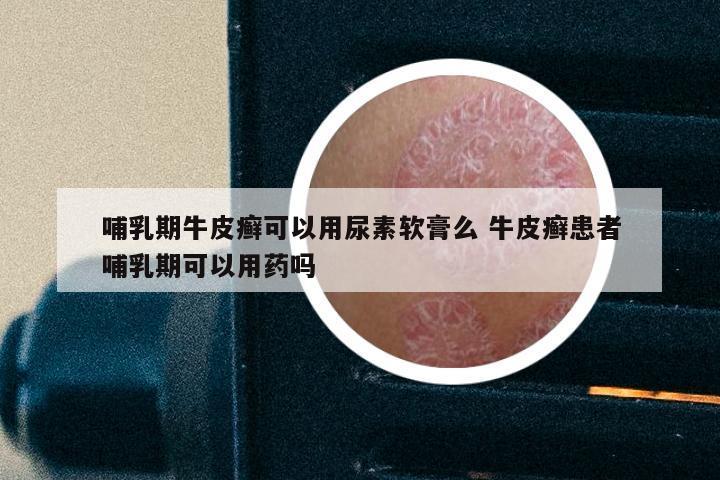 哺乳期牛皮癣可以用尿素软膏么 牛皮癣患者哺乳期可以用药吗