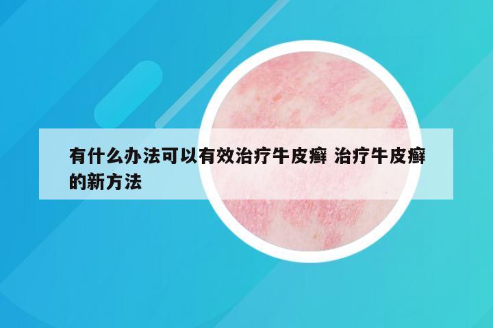 有什么办法可以有效治疗牛皮癣 治疗牛皮癣的新方法