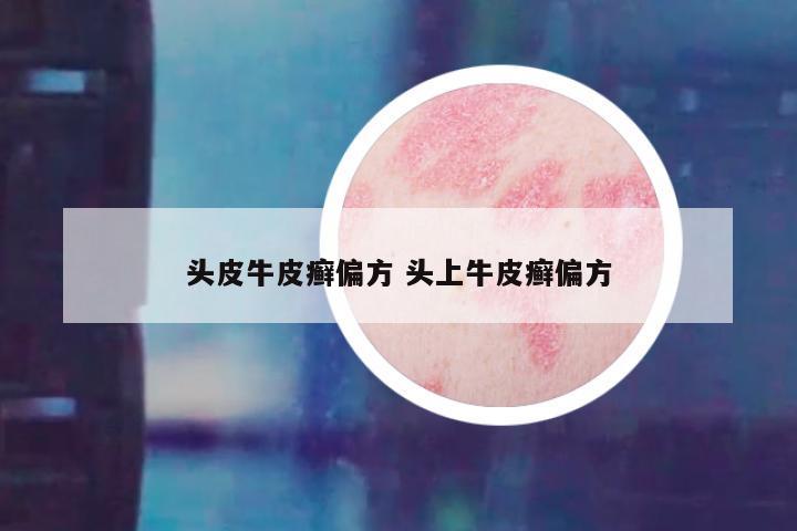 头皮牛皮癣偏方 头上牛皮癣偏方