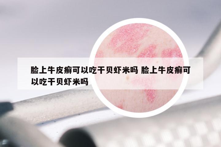 脸上牛皮癣可以吃干贝虾米吗 脸上牛皮癣可以吃干贝虾米吗