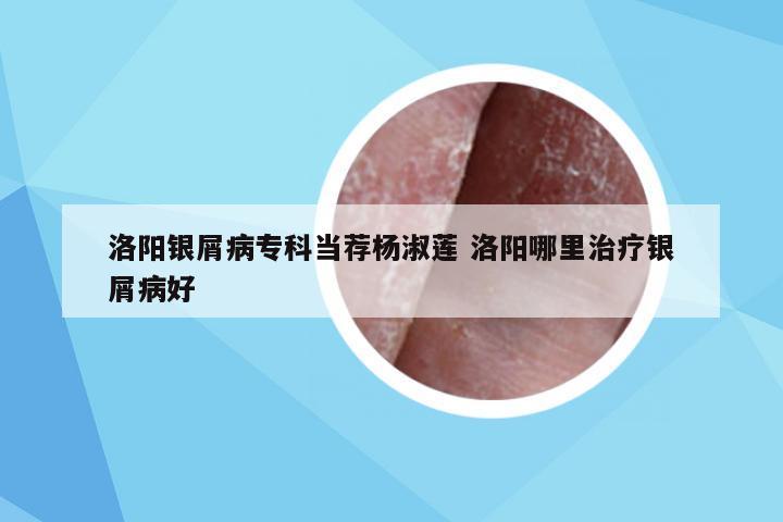洛阳银屑病专科当荐杨淑莲 洛阳哪里治疗银屑病好