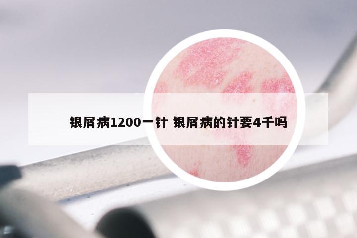 银屑病1200一针 银屑病的针要4千吗