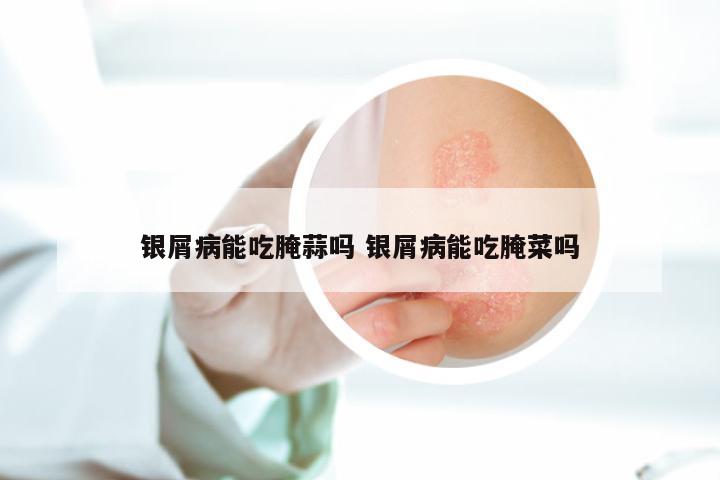 银屑病能吃腌蒜吗 银屑病能吃腌菜吗