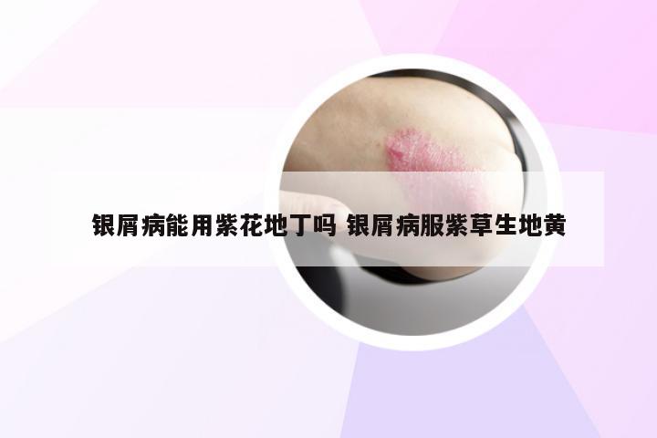 银屑病能用紫花地丁吗 银屑病服紫草生地黄
