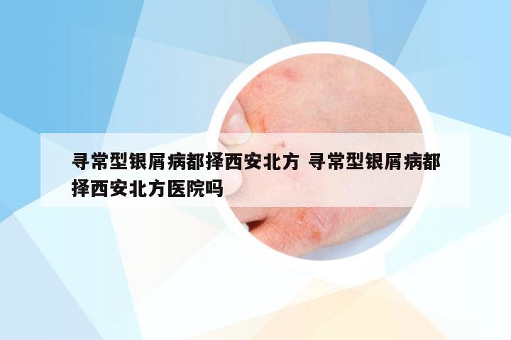 寻常型银屑病都择西安北方 寻常型银屑病都择西安北方医院吗