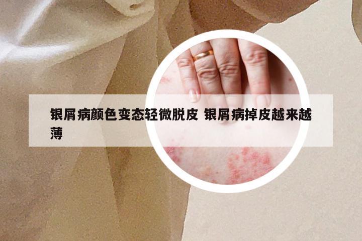 银屑病颜色变态轻微脱皮 银屑病掉皮越来越薄
