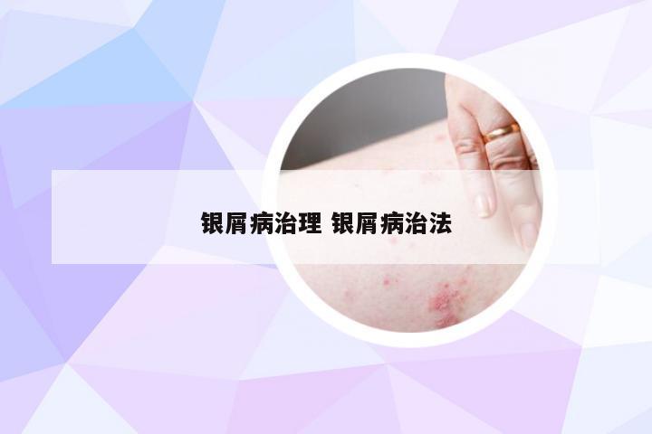 银屑病治理 银屑病治法