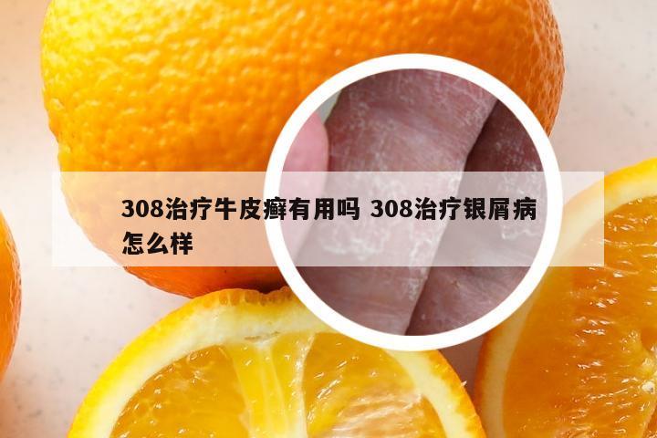 308治疗牛皮癣有用吗 308治疗银屑病怎么样