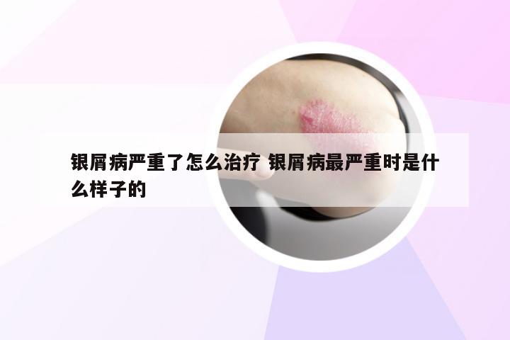 银屑病严重了怎么治疗 银屑病最严重时是什么样子的