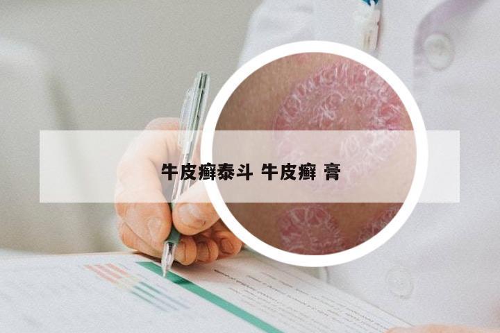 牛皮癣泰斗 牛皮癣 膏