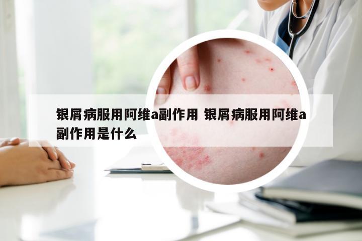 银屑病服用阿维a副作用 银屑病服用阿维a副作用是什么