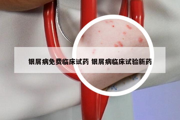 银屑病免费临床试药 银屑病临床试验新药
