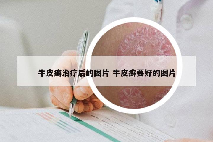 牛皮癣治疗后的图片 牛皮癣要好的图片