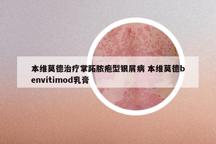 本维莫德治疗掌跖脓疱型银屑病 本维莫德benvitimod乳膏