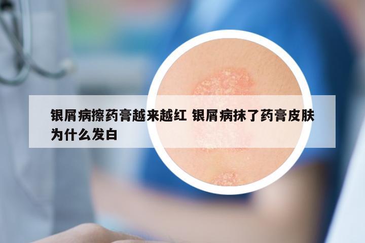 银屑病擦药膏越来越红 银屑病抹了药膏皮肤为什么发白