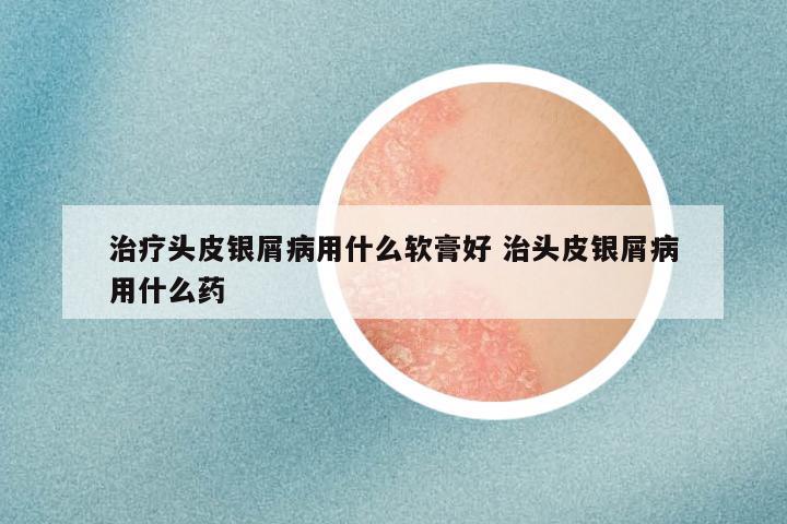 治疗头皮银屑病用什么软膏好 治头皮银屑病用什么药