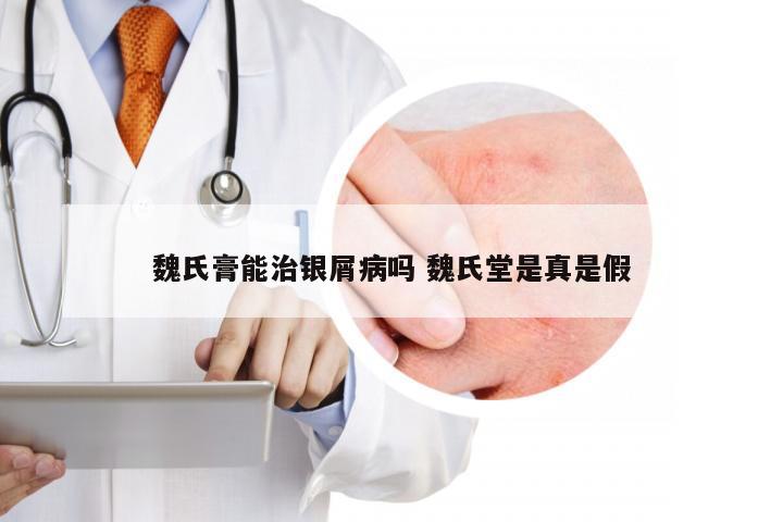 魏氏膏能治银屑病吗 魏氏堂是真是假