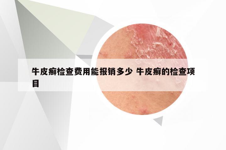 牛皮癣检查费用能报销多少 牛皮癣的检查项目