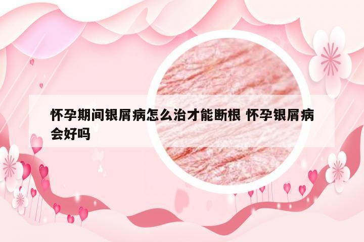 怀孕期间银屑病怎么治才能断根 怀孕银屑病会好吗