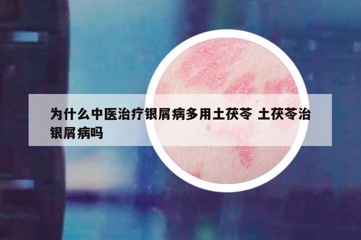 为什么中医治疗银屑病多用土茯苓 土茯苓治银屑病吗