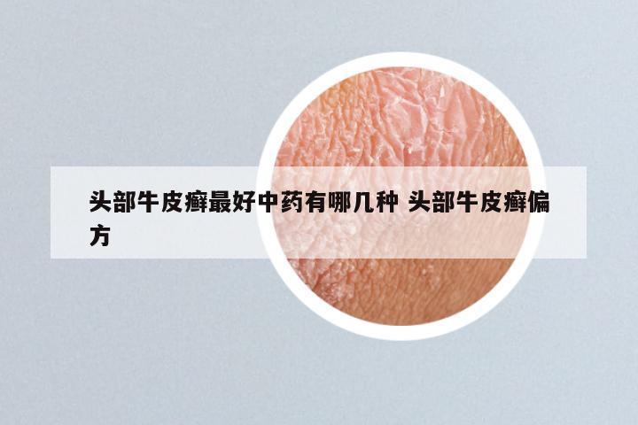 头部牛皮癣最好中药有哪几种 头部牛皮癣偏方