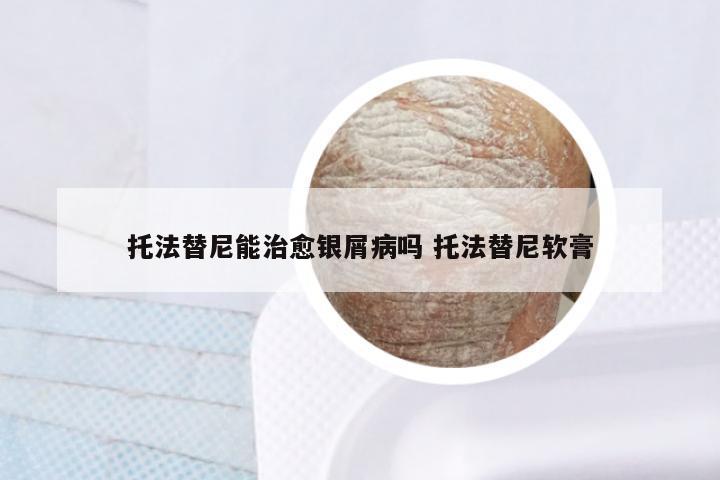 托法替尼能治愈银屑病吗 托法替尼软膏