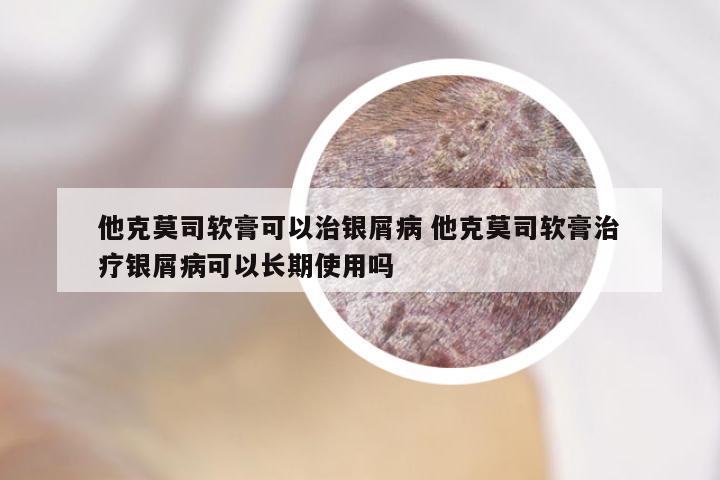 他克莫司软膏可以治银屑病 他克莫司软膏治疗银屑病可以长期使用吗