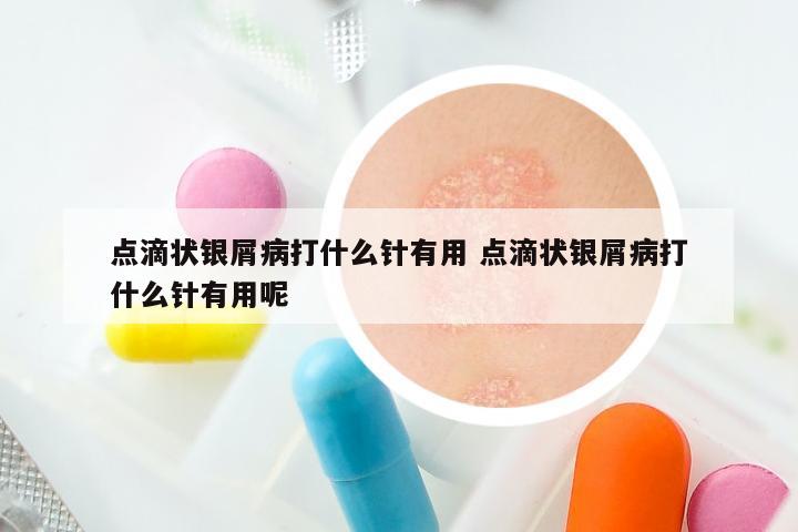 点滴状银屑病打什么针有用 点滴状银屑病打什么针有用呢