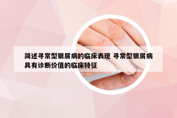 简述寻常型银屑病的临床表现 寻常型银屑病具有诊断价值的临床特征