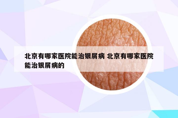 北京有哪家医院能治银屑病 北京有哪家医院能治银屑病的