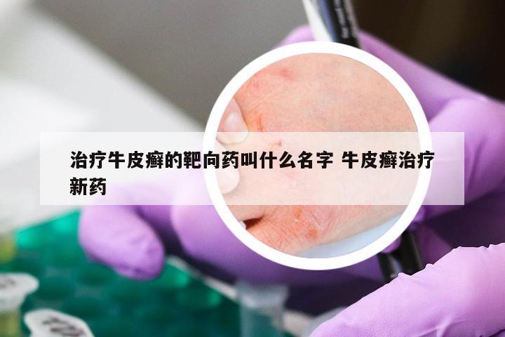 治疗牛皮癣的靶向药叫什么名字 牛皮癣治疗新药