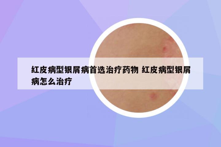 红皮病型银屑病首选治疗药物 红皮病型银屑病怎么治疗