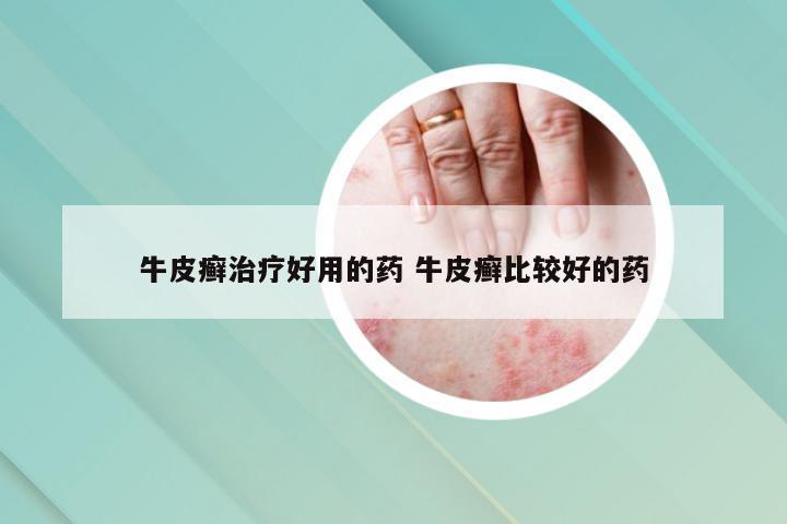 牛皮癣治疗好用的药 牛皮癣比较好的药