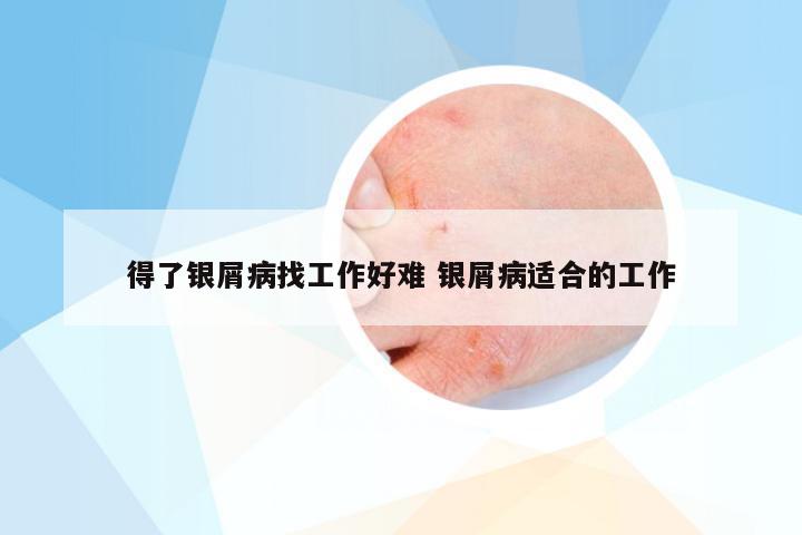 得了银屑病找工作好难 银屑病适合的工作