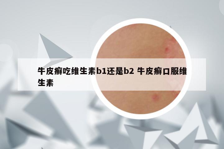 牛皮癣吃维生素b1还是b2 牛皮癣口服维生素